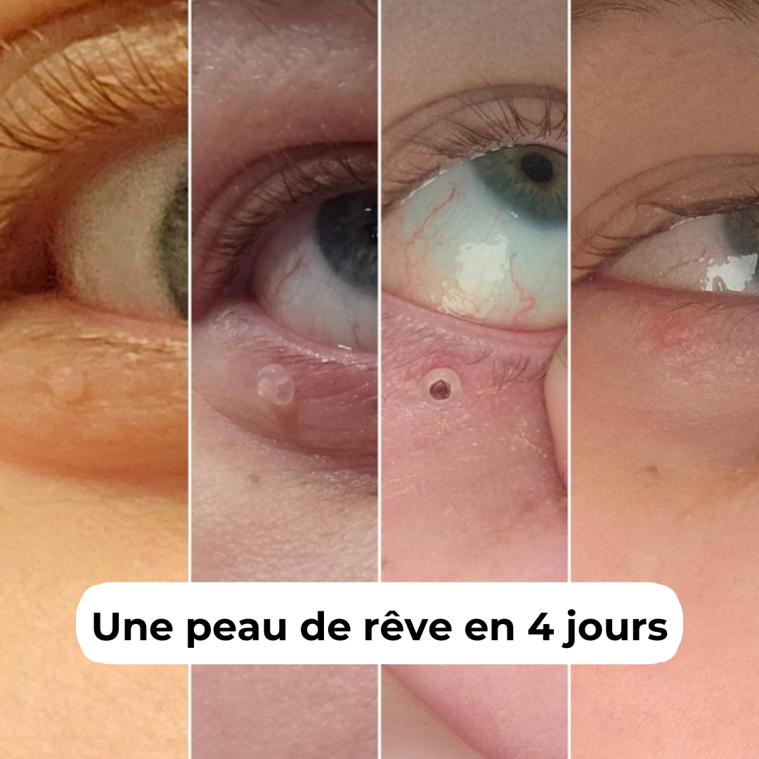Kit complet SKEVIA™ - Adieu les acrochordons