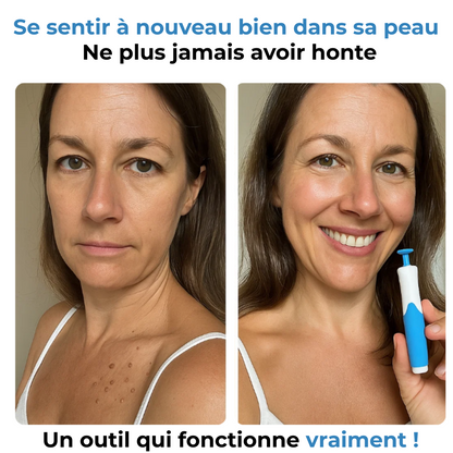 Kit complet SKEVIA™ - Adieu les acrochordons